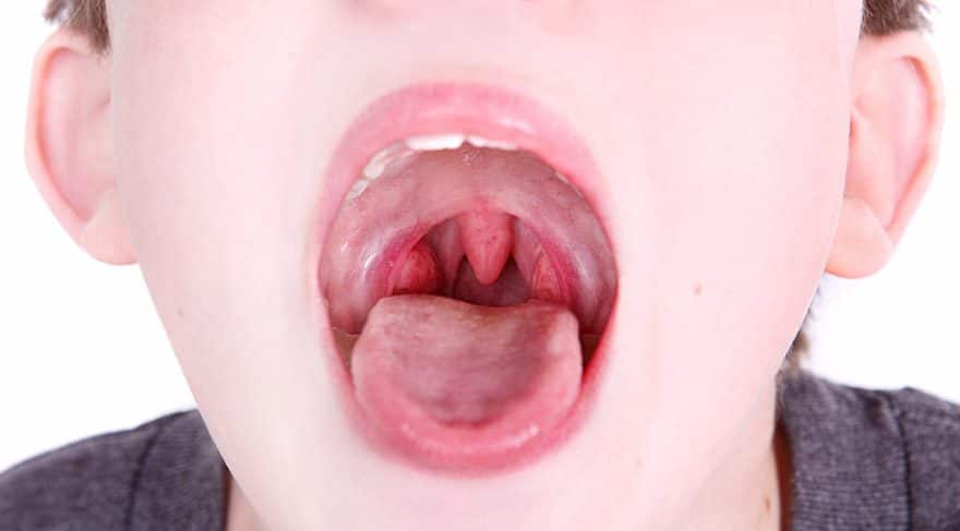 Adenoidlər nədir? Adenoidektomiya (adenoidlərin çıxarılması) necə həyata keçirilir?