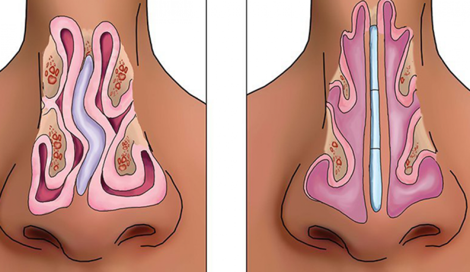 Septoplastika (burun çəpəri əyriliyi əməliyyatı) nədir?